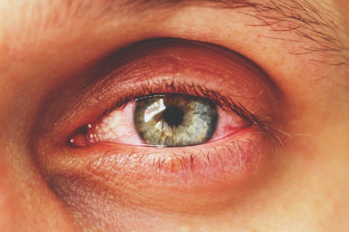 ojos-rojos-nuevo-sintoma-de___ypY0neo-h_720x0__1