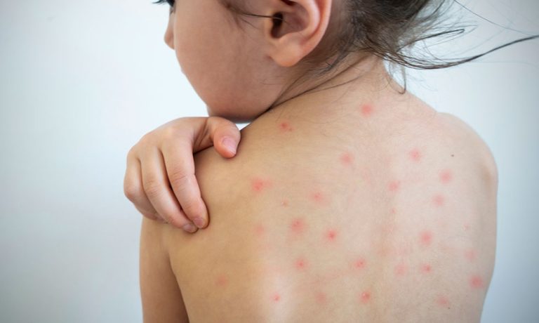 measles-su19